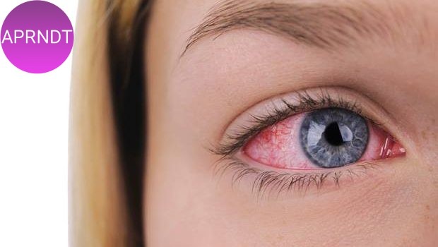 conjuntivitis